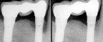 Figure 14  Preoperative view of bone loss around anterior implant affecting adjacent tooth; 1-year post regeneration utilizing bone grafts and growth factor.