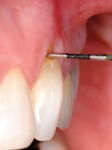 Figure 2   Non-carious cervical lesion on the root surface of a maxillary canine. There is no attached gingiva, the cervical lesion is less than 2 mm in depth, and the recession is Miller Class l.