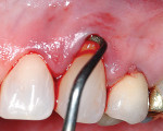 Figure 3  After mobilization of the marginal tissue, the sharp margins of the lesion are flattened and the enamel overhang is beveled.