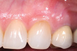 Figure 7   Complete root coverage and a thick, wide zone of attached gingiva with minimal probing depth at 5 years after surgery.