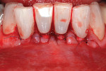 Figure 12   AlloDerm® (BioHorizons, www.biohorizons.com) graft inserted and sutured.