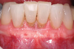 Figure 13  At 6 months after surgery, complete root coverage at the lateral incisors and partial root coverage of the central incisors has been achieved along with a thick zone of attached gingiva. At this time cervical restorations were placed.