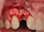 Figure 1  Thick facial bone. This is atypical in the premaxilla, where the facial bone plate is usually thin(< 1 mm).