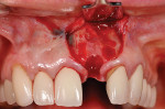 Figure 2  Thin facial bone. Facial fenestrations as illustrated or dehiscences are common over incisors and cuspids in the premaxilla and increase the complexity of implant treatment; they potentially increase the risk for long-term post-restoration