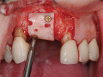 Figure 5  Insertion and stabilization of a shaped allogeneic block graft with fixation screws. Particulate allograft and anoverlying resorbable membrane are subsequently adapted to the surgical site (not shown).