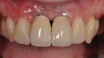 Figure 9  Ten-year follow-up on implant restorations in sites No. 8 and 9. Note the mild facial recession, titanium shine-through, and blunted inter-implant papilla.