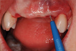 Figure 11  Connective tissue graft preparation with a microsurgical knife on the facial of implants in the sites No. 7 and No. 10 to improve the tissue quality and volume.