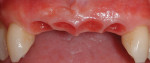 Figure 12  Tissue form has been defined in the pontic and implant sites with a provisional restoration.