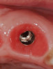 (21.) Provisionals, anterior, open view. Note the composite tops on the posterior teeth and improved planes of occlusion.