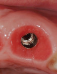 Figure 18   Following immediate implant placement and provisionalization, the removal of the temporary crown reveals a healthy and shaped gingival sulcus of favorable volume.