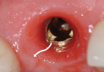 Figure 21  Under-contouring of a CAD/CAM designed abutment results in greater soft tissue volume in the subgingival prosthetic envelope. Support for the free gingival margin is limited to the cervical 0.5 mm to 1 mm of the abutment and crown.