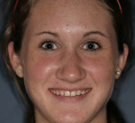 Figure 1   Full facial image of a young adult female illustrating the esthetic problems associated with congenitally missing maxillary lateral incisors.
