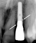 Figure 23  Deep cement is evident on the mesial and distal surfaces of the implant collar to the level of the first thread. Cement cannot be seen on the facial or palatal surfaces. Bone loss is evident in this case, because the retained cement was no