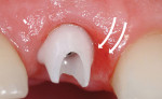 Figure 24  A custom zirconia abutment, which is not ideally designed and does not follow the interproximal rise of the gingival tissue as developed with a provisional restoration.
