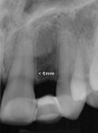 Figure 25  Preoperative radiograph. Congenitally missing tooth No. 10 presents limited space me