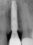 Figure 26  Postoperative radiograph. A small-diameterimplant (3 mm) was ideally placed 3-dimensionally.