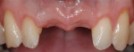 Figure 27  Preoperative view of a healed ridge withvertical loss of gingival height. Note the blunting of the papilla on the adjacent teeth, which limits the post-restoration implant papilla height that can be expected.