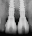 Figure 28  Radiograph on the day of surgery:Implant placement and provisional restoration.Note that the implants are subosseous, as their position is defined by the desired facial free gingival margin position.