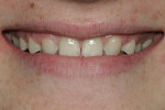 Figure 2  Natural smile at 1:2 magnification showing the interproximal spaces and large incisal embrasures.<