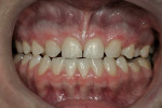 Figure 3  Retracted 1:2 magnification image reveals significant functional wear of the upper incisors not protected by properly positioned maxillary cuspids.