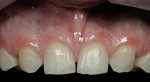 Figure 4  Retracted 1:1 view reveals incisor wear from chipping.