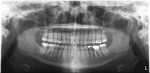 Figure 1  A panoramic radiograph of an adult, acquired on a solid-state panoramic imaging unit.