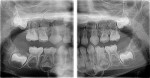 Figure 2 A panoramic bitewing radiograph of a child in the mixed dentition stage. This is a portion of a panoramic imaging layer engineered to open the proximal dental contacts. Studies are being conducted relative to the diagnostic utility of this i