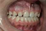 Figure 5  Retracted 1:2 right lateral image shows how the anterior teeth directly oppose each other in maximum intercuspation.