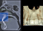 Figure 1   2-D sagittal grayscale image and 3-D color rendering of the region of interest, a mesiodens, not visualized from the facial aspect. This image and Figure 2 were achieved using a simple 