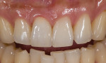 Figure 9  Postoperative image of crown on tooth No. 8.