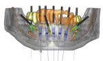 Figure 1  Image of a patient’s plan who is scheduled to have remaining mandibular anterior teeth extracted, alveolectomy, alveoplasty, implant placement, and immediate restoration. All planning can be simulated, including implant positioning re