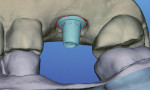 Figure 3  An iTero scan of an implant abutment in articulation.