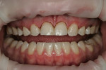 Figure 9  OptraGate<sup>®</sup> (Ivoclar Vivadent) retraction was used after soft-tissue diode-laser gingival recontouring.
