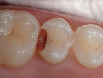 Figure 1  Preoperative view. The pre-existing restoration failed due to recurrent decay.