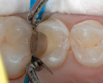 Figure 4  Virtually all of the exposed dentin was covered with a thin layer of the RMGI liner, and a bevel of approximately 45° was placed on the enamel margins.