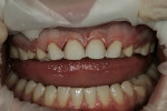 Figure 11  Etched enamel throughout the prepared surface of the tooth verifies the minimal preparation that was performed.