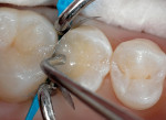 Figure 8  The author utilized a horizontal placement technique for the dentin increments. A2 Body shade composite was utilized for the dentin increments.