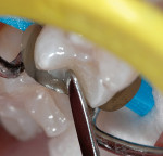 Figure 9  A lateral placement technique was utilized for enamel increments. The first increment was pulled toward the buccal margin, smoothed, and light polymerized. A1 Enamel shade composite was used for the enamel increments.