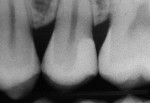Figure 11  Postoperative radiograph  demonstrating proper gingival embrasure form and what appears to be a well-integrated and homogenous restoratio