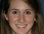 Figure 13  Full-face image of young adult with her definitive restorations.