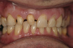Figure 10  At the final visit, provisional crown preparations and caries control composites were removed. Note that caries on tooth No. 11 have also been addressed.
