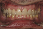Figure 12  After crowns were inserted, teeth Nos. 7 and 8, as well as the final composite restorations on teeth Nos. 5, 6, 9, 10, 11, and 12, were completed.