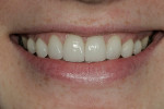 Figure 14  Postoperative image of the patient’s smile.