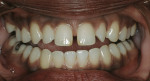 Figure 4  Preoperative view of a patient with noticeable diastema.