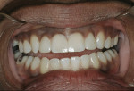 Figure 8  View of the composite restorations after the second appointment for finishing and refining.