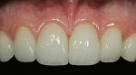 Figure 18  A 1:1 magnification view showing the characterization of the IPS Empress Esthetic veneers.