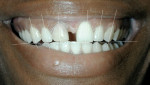 Figure 10  Unretracted view of the patient's smile showing axial inclinations of the six maxillary anterior teeth, incisal edge  relationship to the lower lip (smile line), and high lip line.