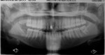 Figure 12  View of the panoramic radiograph taken after prophylactic root canal therapy was performed on tooth No. 8. A composite core build-up was used after endodontic access.
