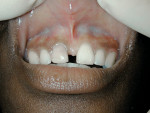 Figure 13  Preoperative frenectomy and gingivoplasty view. The low attachment of the frenum can be seen pulling on the tissue between the central incisors and has caused an attachment mass on the lip.