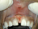 Figure 14  Postoperative frenectomy view. The frenectomy and resection of the tissue attachment mass on the lip was accomplished using a CO2 laser.